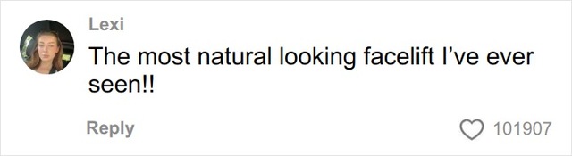 Social media users hail the procedure as "the most natural-looking facelift" ever documented.