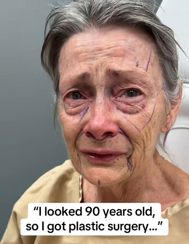 The 70-year-old patient prepared for surgery, marked for a deep-plane facelift restoration.