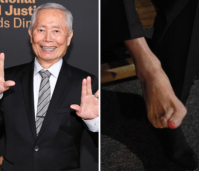 The Congenital Foot Deformity of George Takei
