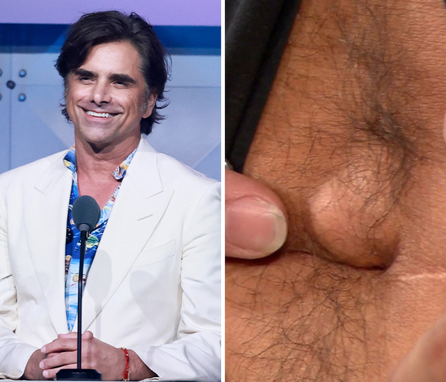 The Deep Umbilical Scar of John Stamos
