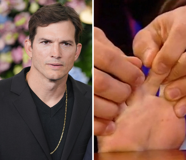 The Webbed Syndactyly Toes of Ashton Kutcher