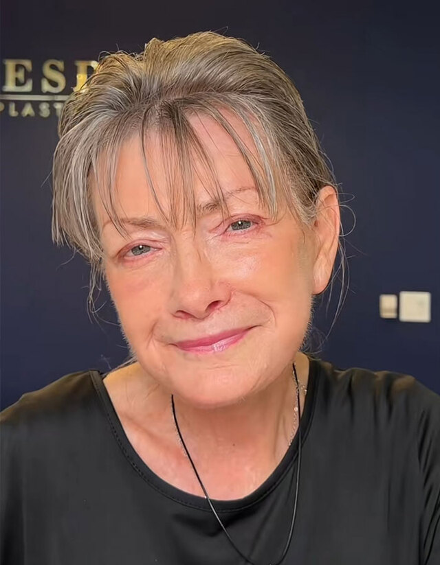 The stunning results: A refreshed, natural look that the patient claims "took 30 years off."