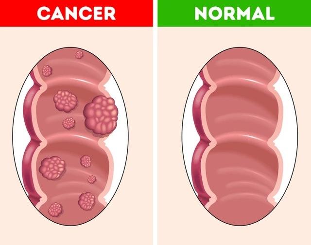 We are seeing a dramatic, alarming rise in colon cancer diagnoses in young, active adults in their 20s and 30s.