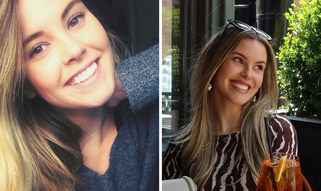 Anna Redman: Embracing the Subtlety for a Gummy Smile