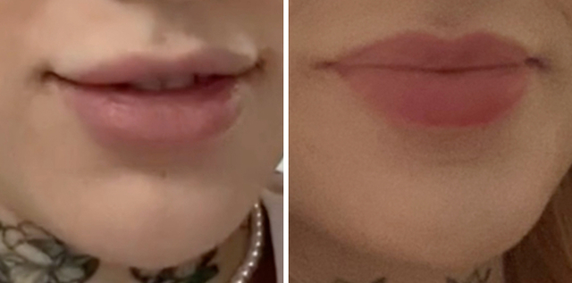 Jazzmyn Wollfe: Reclaiming Natural Contours After Filler Migration