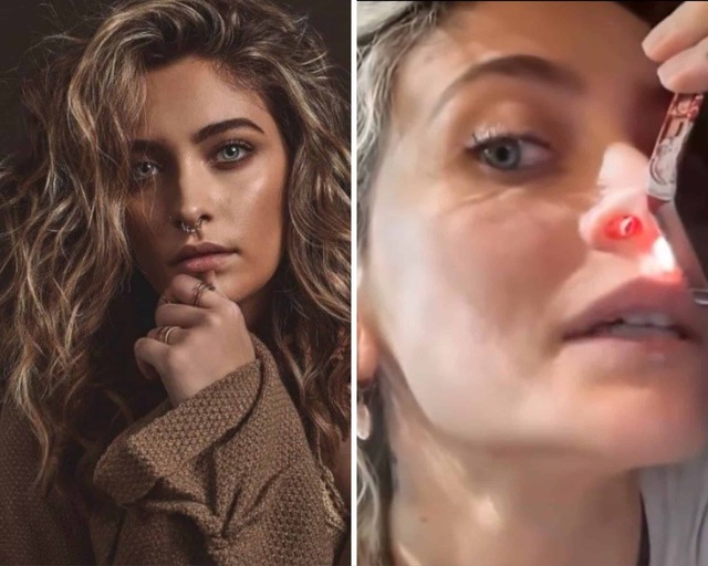 The Eroding Mask: Unveiling the Graphic Reality and Hidden Costs of ‘Coke Nose’